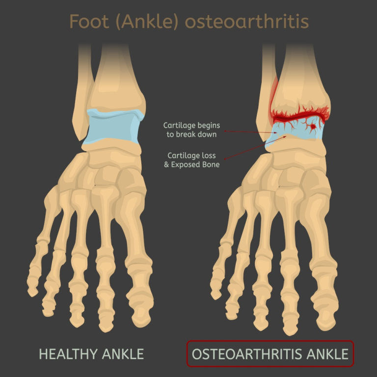 Artrosi Della Caviglia Cause Sintomi E Cure Crosystem
