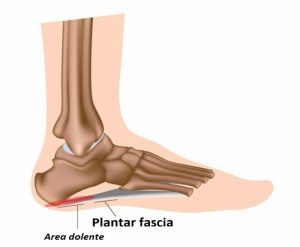 fascite plantare sintomi
