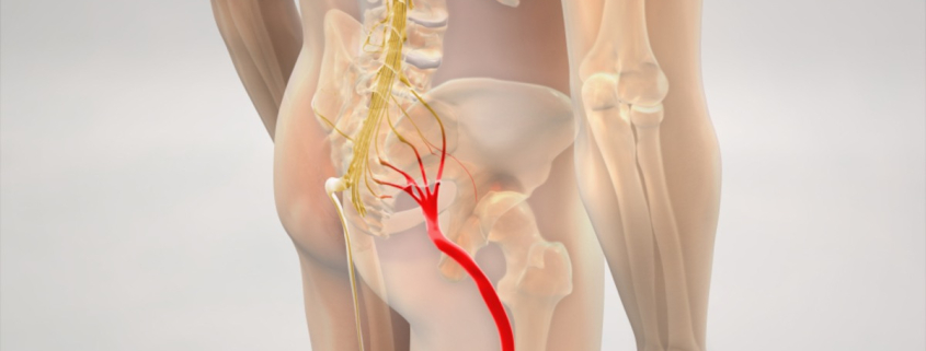 sciatica
