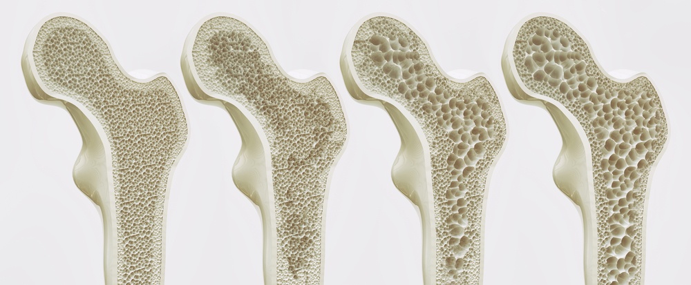 Osteoporosi  cause e cure: meccanismo