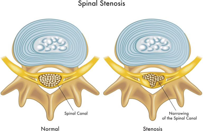 stenosi-del-canale-vertebrale-cause-sintomi-e-possibili-cure-cro-system