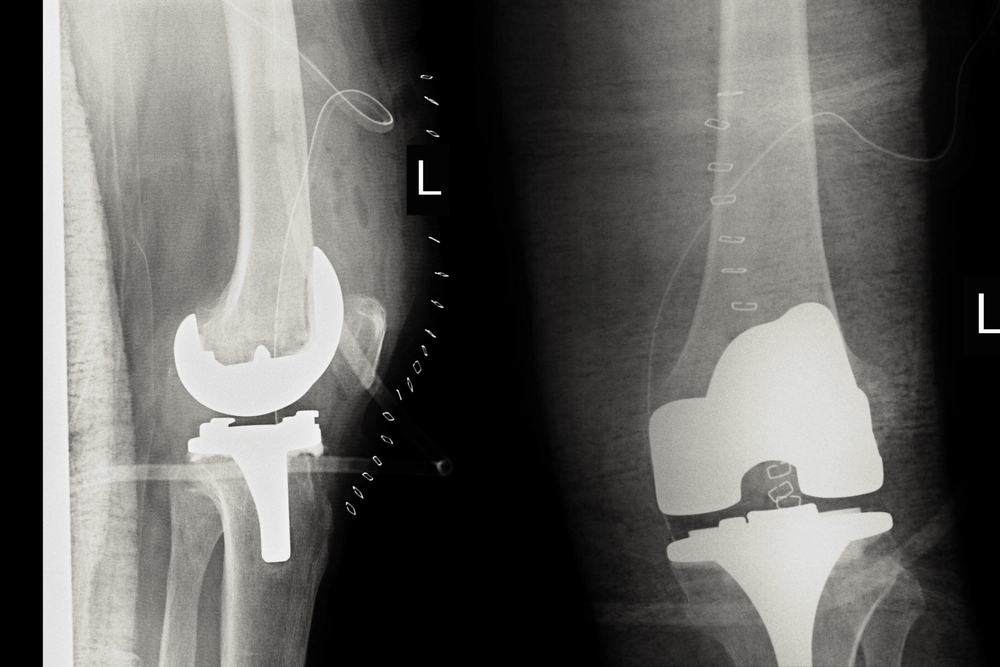 protesi ginocchio riabilitazione