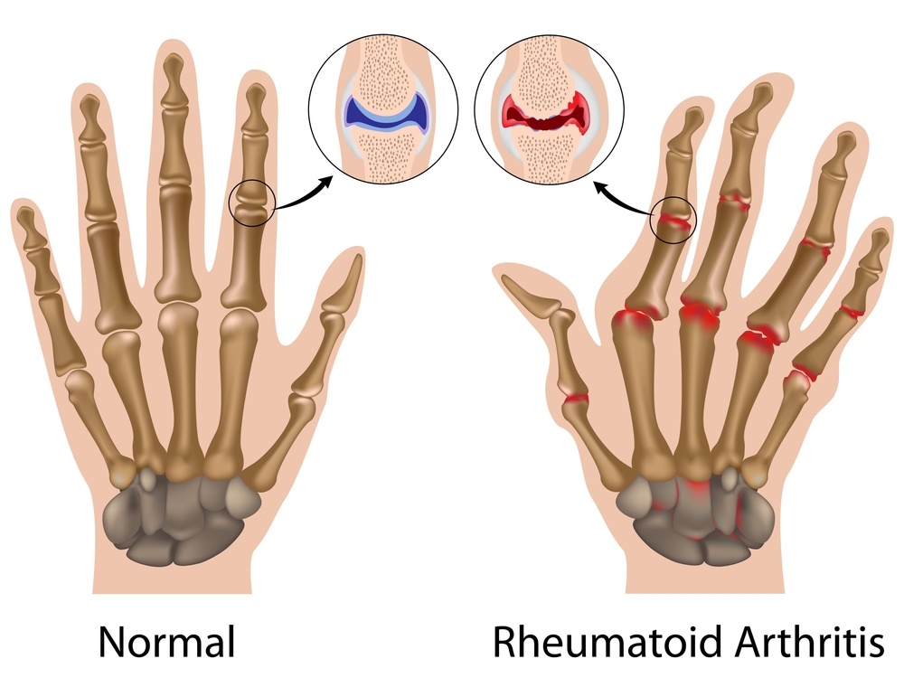 artrite reumatoide sintomi crosystem