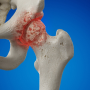 artrosi anca sintomi