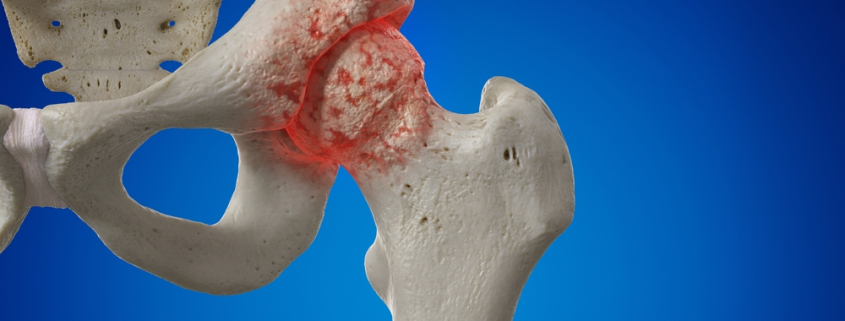 artrosi anca sintomi