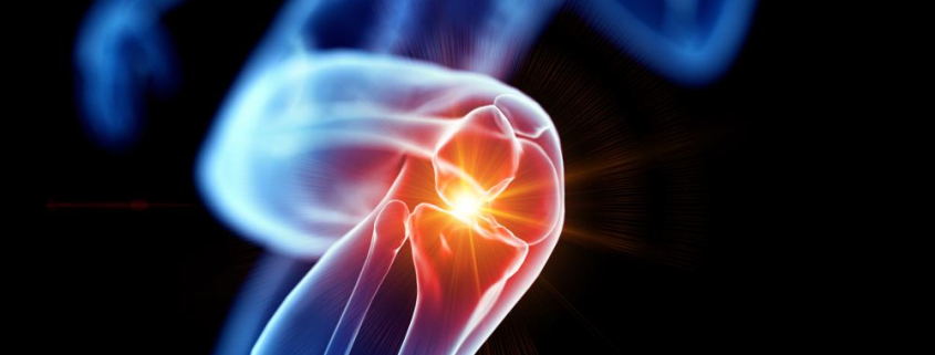 artrosi del ginocchio gonartrosi