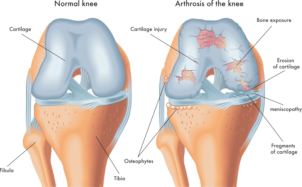 artrosi del ginocchio gonartrosi come si manifesta