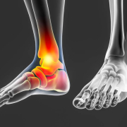 artrosi della caviglia
