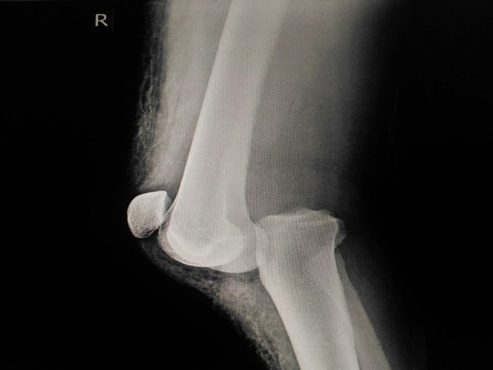lussazione ginocchio diagnosi