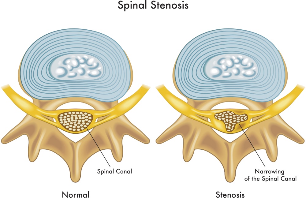 stenosi del canale vertebrale cause