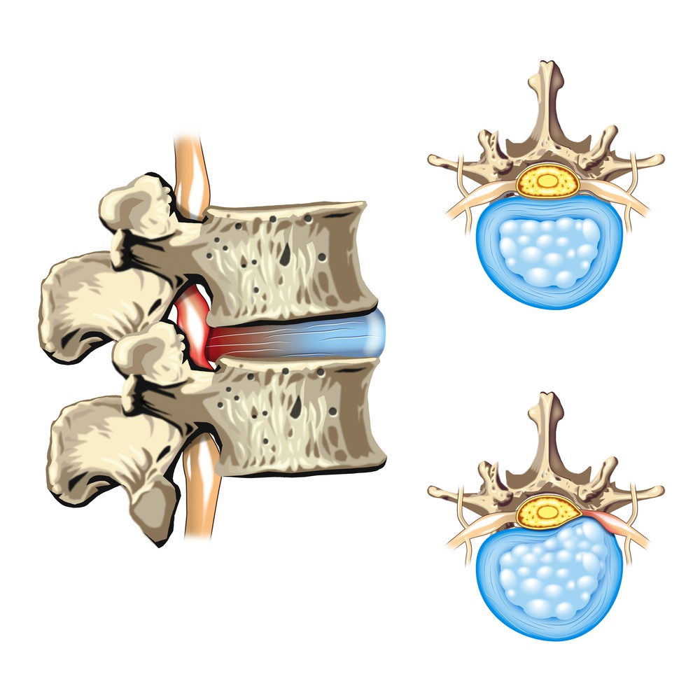 stenosi del canale vertebrale ernia del disco