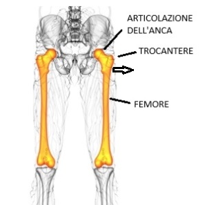 Trocanterite e spostamentod el femore Capire la trocanterite. Trocanterite da lieve spostamento del femore